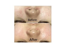 ミー(ME.)/２０代女性（肌荒れ）