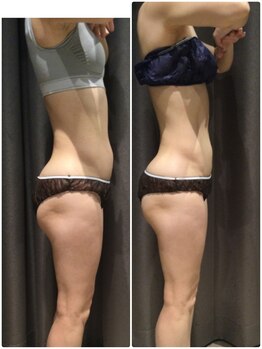 アイスタイル(i-style)/脂肪冷却/痩身ダイエット/泉大津