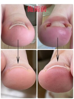 一宮巻き爪センター/陥入爪