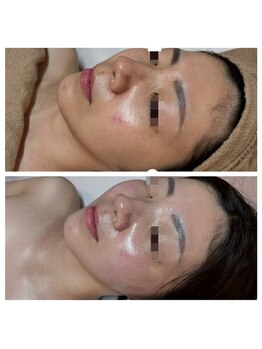 クリア 栄生(CLEAR)/艶が出て毛穴縮小!