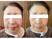 ルポ 那覇(repos)/リフトアップ特化美容鍼