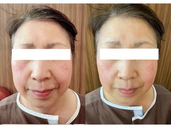 ルポ 那覇(repos)/リフトアップ特化美容鍼