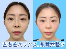 ナチュラルパーフェクトフェイス 新宿/新宿小顔矯正/ブライダル/歪み