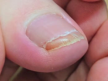 ◆痛みの少ない巻き爪補正☆