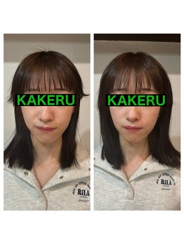 カケル鍼灸整体院(KAKERU鍼灸整体院)/美容鍼ビフォーアフター