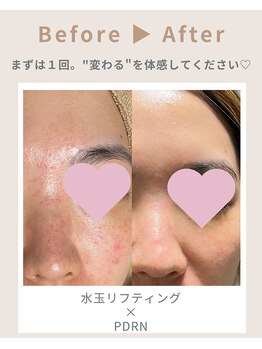 ミラクレア(Mira Crea)の写真/【韓国話題のLDM水玉リフティング×リジュランPDRN】お悩みに合わせて高濃度美容アンプル導入☆