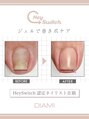 エム ネイル(M nail) 巻爪ケア ジェル