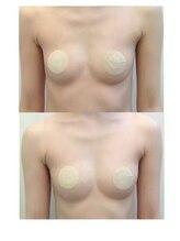 ルミエール(Lumiere)/【倉敷市】バストアップ施術事例