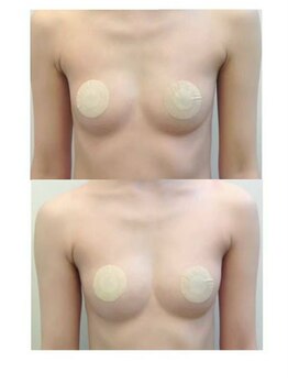 ルミエール(Lumiere)/【倉敷市】バストアップ施術事例