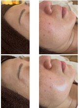 プリュムアイ フェイシャルホーム(prume eye.facial home)/ハーブピーリング初回