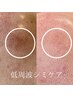 【レーザーが苦手】低周波シミケア プログラム13分当て放題体験♪
