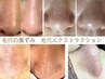 【人気No1開き/黒ずみ】毛穴エクストラクション＋高濃度ビタミンC導入 ￥11000