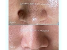 クトナ(Qutona)の雰囲気(毛穴に悩む毎日はもう卒業する!そう決めた方お待ちしています♪)
