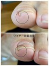 【巻き爪ケア】フットケア