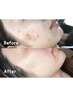 【全米No.1★究極肌管理】エステ版ダーマ美肌 ¥20,000→¥9,000