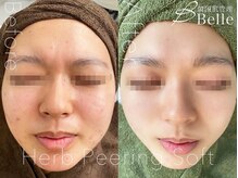 ベル 熊本店(Belle)/ハーブピーリング｜ニキビケア