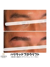 アクシア ビューティー サロン(AXSIA)/【HBL】BeforeAfter