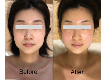 ミピマムマリール(Mipimam Marire)/Before、After