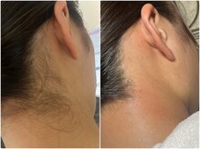 スパークル/うなじワックス脱毛