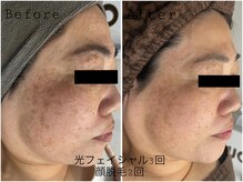 レイズ(RAISE)/乾燥・美肌ケア　光フェイシャル