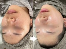 赤み、敏感肌、オイリー肌色んな肌質の方に受けていただけます☆