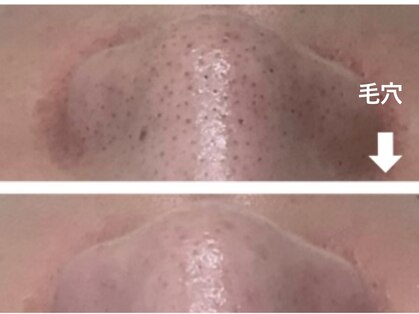 【医療提携】ヒト幹細胞原液100% Re.GLARE新宿/毛穴洗浄/ハイドラ/ハーブ/肌荒れ/小顔の写真