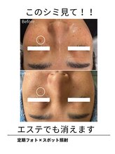 エイチケービューティーサロン(H/K beauty salon)/【スポット照射】