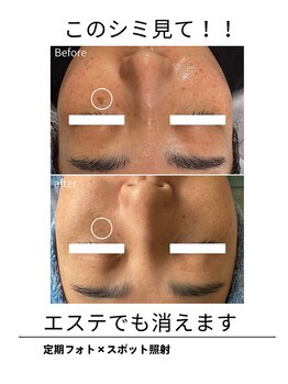 エイチケービューティーサロン(H/K beauty salon)/【スポット照射】