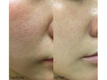 ニュイブラーシュ(nuit blanche)/REVIハーブピーリングニキビケア