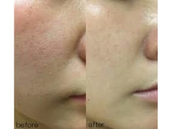 ニュイブラーシュ(nuit blanche)/REVIハーブピーリングニキビケア