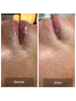 エルモア(L-MORE)/毎日の髭剃りから解放されよう