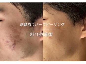 ライフサロン 別府(Life Salon)/ハーブピーリング