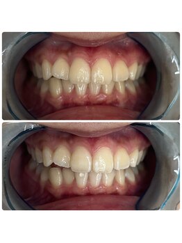 グリッター ショウナン(glitter. SHONAN)/藤沢ホワイトニングbefore/after