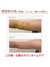 6月限定★55％OFF【二の腕orお腹or背中の術後ケア】インディバ 60分15,000→