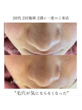 エーサロン(A-Salon)/毛穴ケア