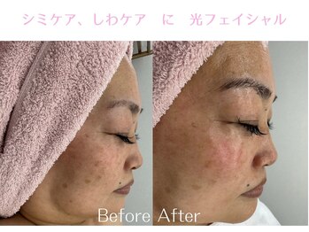 Cスキンケアクリニック 麻布店/光フェイシャルBeforeAfter