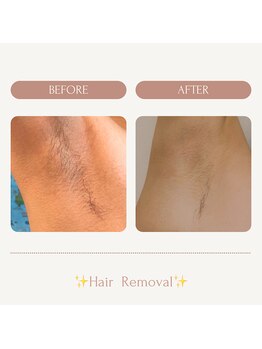 サロンエピ(Salon Epi)/脇脱毛/メンズ脱毛/京都