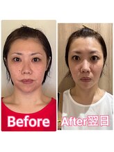 小顔矯正サロン ブルーム/施術1回のビフォーアフター