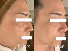 エルティナ(#LTIENA)/ビオフィートで糖化ケア