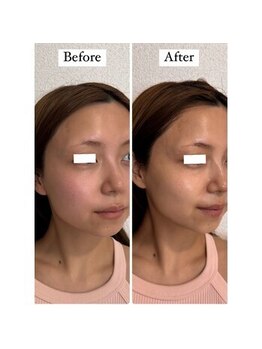 ティアラ(TIARA)/【小顔、たるみ】テラボーラー