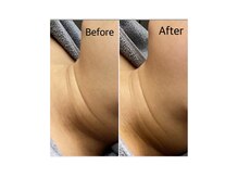 ミー(ME.)/２０代女性（首のたるみ）