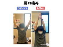 美波整体院 本宮院/肩こり肩の痛み(Before After)