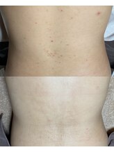 チュチュ(TUTU)/マイクロニードルピール