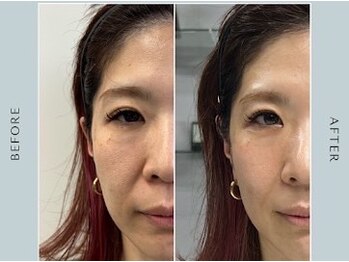 リノージュ(Linoju)/医師監修ExoLift ［エクソリフト