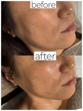 レオ(LEO)/before→after