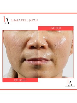 ナル ゆあん鍼灸接骨院(nalu)/ララピール◇毛穴を引き締め◎