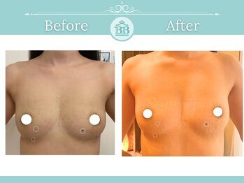 美人バスト 新潟店/ 【バストアップ★育乳】症例