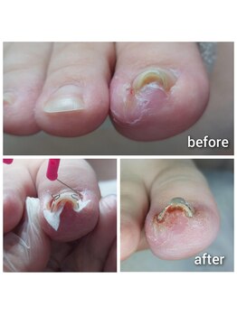 爪切り屋 足楽/オルトグリップシュパンゲ