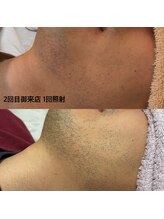 モルト(MOLT)/ひげ脱毛１回照射　３週間後来店