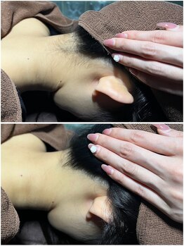 ミスターアンドミス脱毛専門店 難波店(Mr.&Ms.脱毛専門店)/えり足・うなじ脱毛